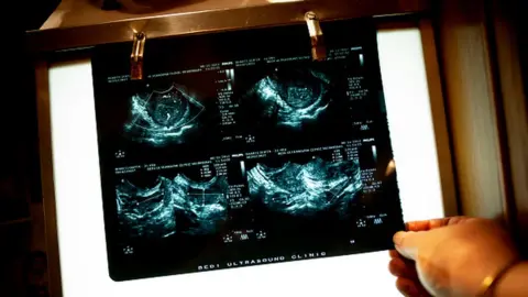 Getty Images A pregnant woman's ultrasound