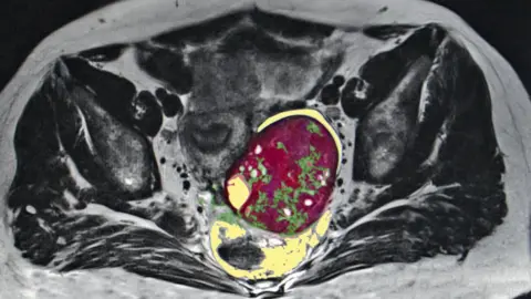 Getty Images Ovarian cancer scan