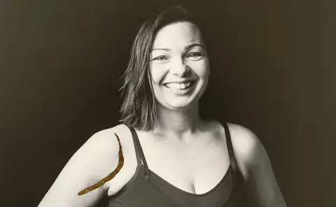 Carol Holliday/Ryan Davies A black and white image of a female patient with a scar on her shoulder filled in with gold leaf