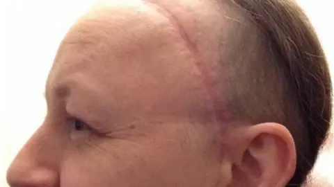 Brain Tumour Research Woman's head, showing red operation scar