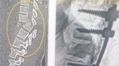 Handout A black and white x-ray image of Johnson's broken spine.