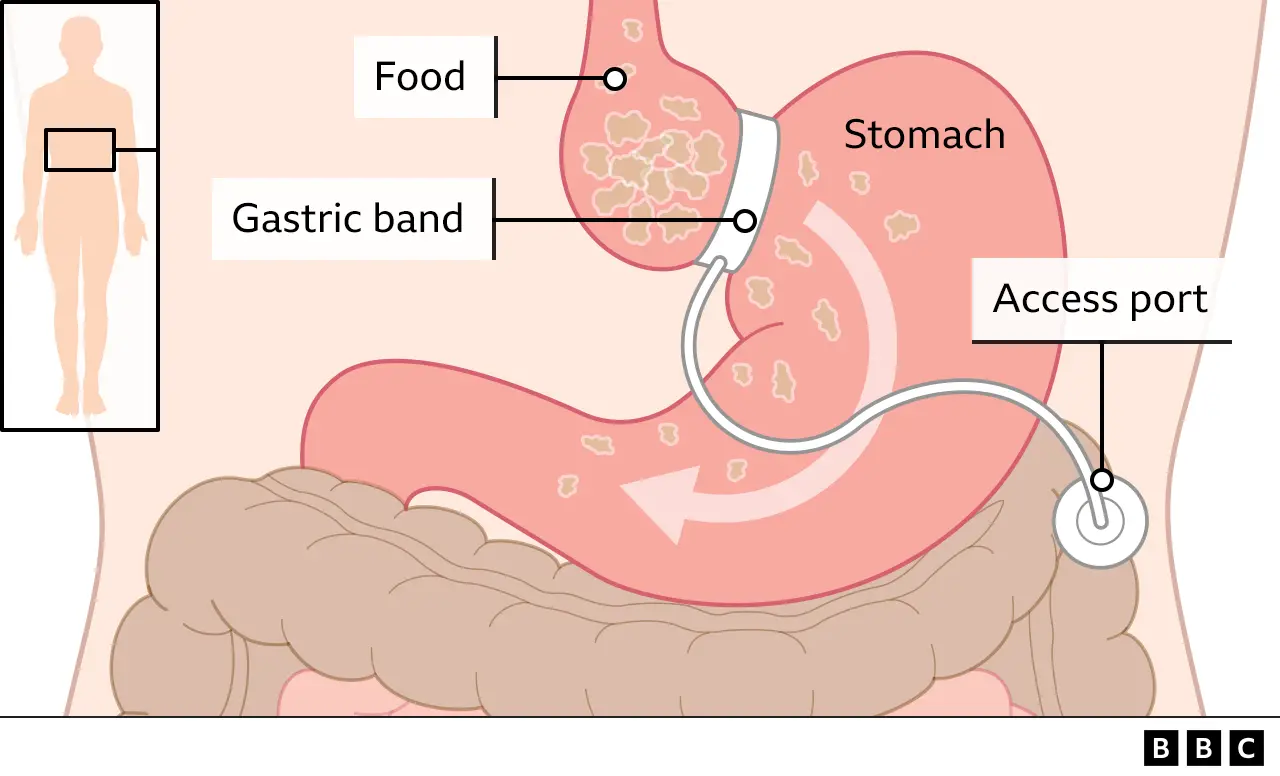 My Gastric Band Isn't Working: What Now?: Mikhail A Botvinov, DO, MD:  Bariatric and Minimally Invasive Surgery