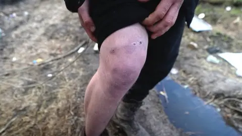 Lee Durant / BBC Image shows bullet wound to knee