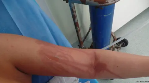 Phoebe Georgiou Photo showing burn to Phoebe's arm