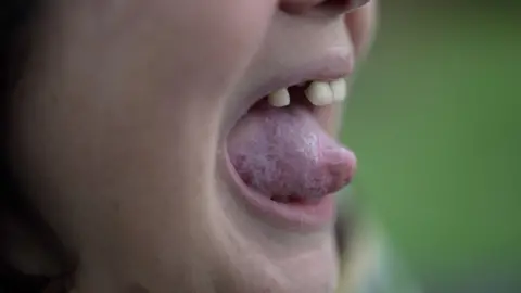 Sinead Marland was 39 when she noticed a lump on her tongue