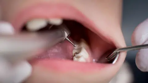 Getty Images Dentist working on patient's teeth