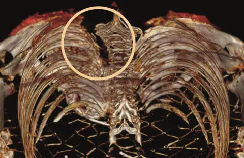 University of Manchester and R.D.Loynes Scan showing stab wound