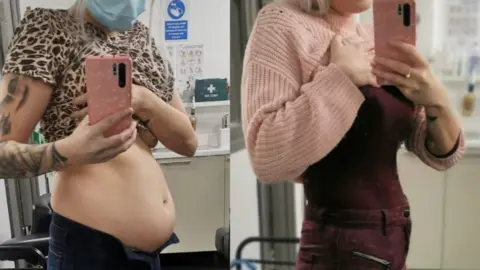 Charl Davies  Comparison of bloating in the midriff