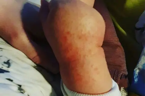 Jade Roberts Bertie's hand with the rash