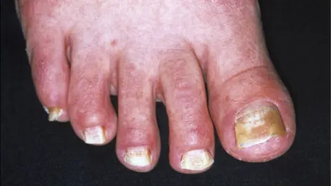 Fungal Nail Disease On Leg Stock Photo 1191640072 | Shutterstock