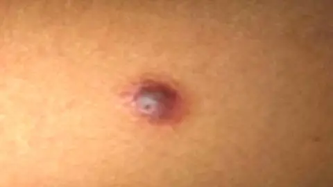 Kass Barker Kass's melanoma