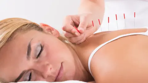 Getty Images A woman having acupuncture