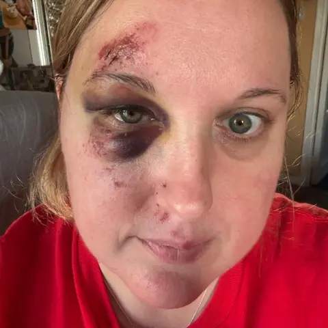 Sharon Williams Sharon, wearing a red top, with a black eye and grazes on her face