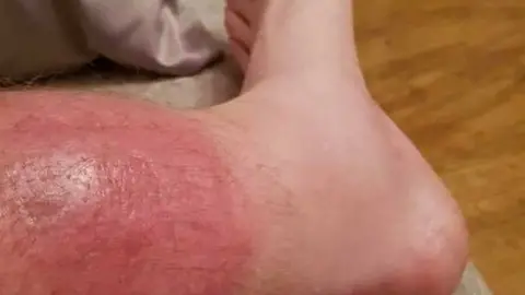 Alex Williams Infected leg