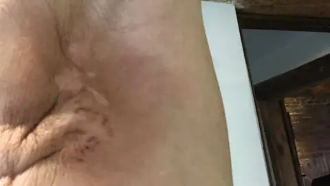 Liz O'Riordan Armpit post-surgery