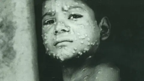 Universal History Archive/Getty Images Last indigenous case of smallpox in India, seven-year-old boy Manjo, May 1975