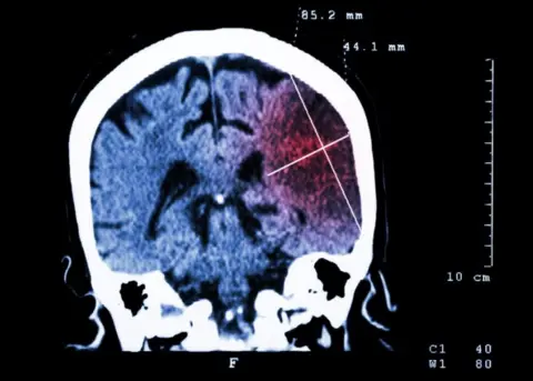 Getty Images CT scan of brain and stroke