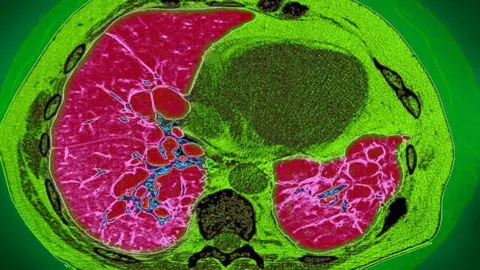 Getty Images MRI scan revealing a build-up of mucus in the respiratory tract