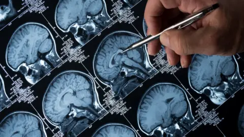 Getty Images MRI brain scan, with hand pointing