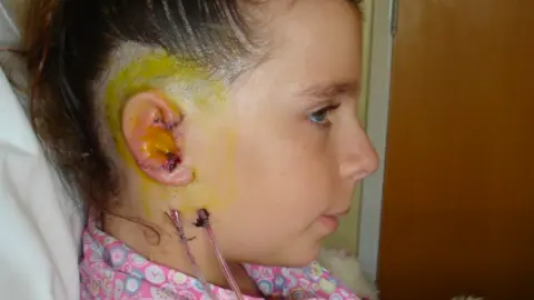Supplied Olivia Howe, aged 10, in hospital viewed in profile showing the result of the operation to reconstruct her ear