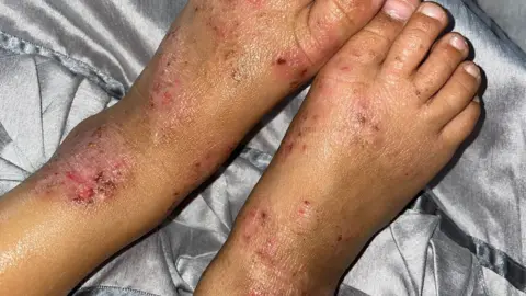 Kate Bradbrook/BBC Kyden's eczema