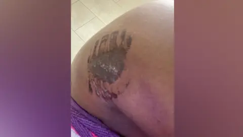 A mark left by a bite on Selma Taha's body