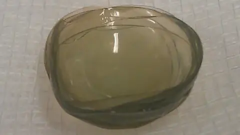 BMJ Mass of 17 contact lenses found in the patient's eye