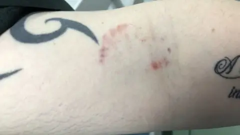 West Midlands Ambulance Service Bite on arm