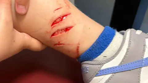 Jess Turnock A young boy's leg with four gashes and scratches. He is wearing white and blue socks and a white, blue and grey Nike trainer.