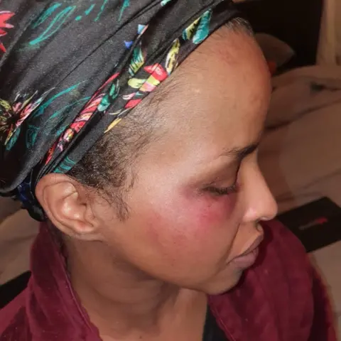 Niyad Farah with black eye