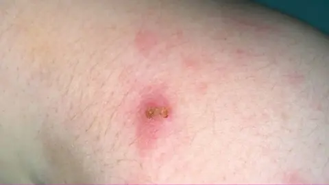 Eve Keeling A scab under Eve's arm from where she was injected