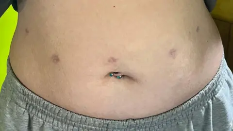 Sheffield Teaching Hospitals Stomach of patient showing five keyhole scars