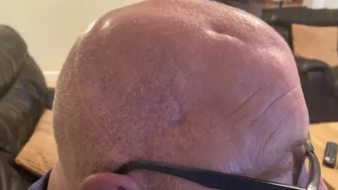 A close-up of the scars on Jeremy's scalp