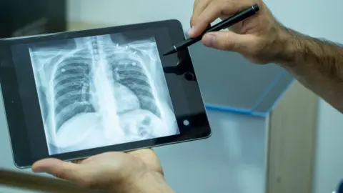 Getty Images Chest x-ray of a patient with tuberculosis