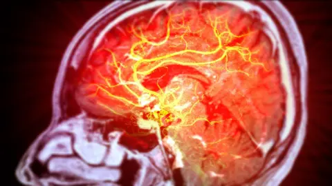 Getty Images An image shows an X-ray of a human brain