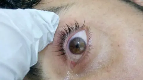 SAMS Severely constricted ("pinpoint") pupil of a man injured in attack near Latamina on 30 March, according to the Syrian American Medical Society