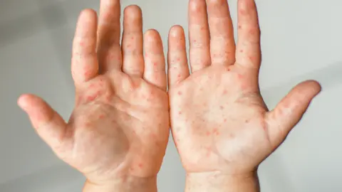 Getty Images Cocksackie hand, foot and mouth rash