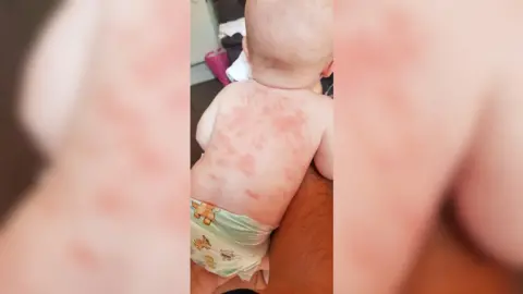 Hannah Godwin Baby Leia on her front, displaying rash of atypical Kawasaki Disease