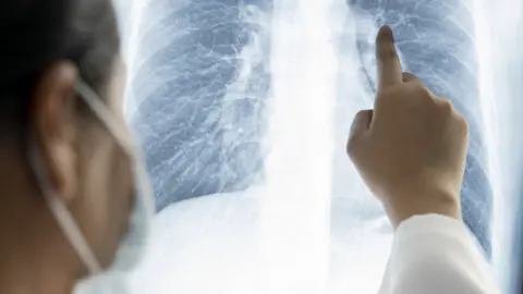 Getty Images Doctor looking at lung X-rays