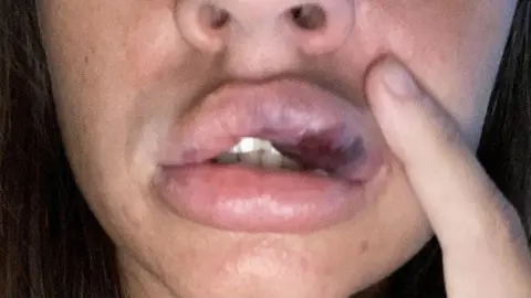 BBC Botched lip filler