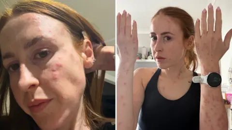 Hannah Stephenson A composite of two pictures of Hannah Stephenson. On the left is a close-up picture of her face, which has a series of red raised lumps on her forehead, cheek and jaw. On the right is Hannah standing with both arms bent at the elbows and facing upwards towards the camera. She is wearing a black top and has a sports watch on her wrist. Her hair is tied back, and there are bite marks across both arms, her chest and face.