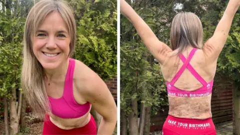 Jodi Whitehouse A split picture of Jodi Whitehouse. In the picture on the left she is smiling directly at the camera while wearing a pink sports top. In the picture on the right you can see her back which is covered in marks. Her arms are raised.