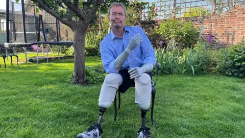 BBC Conservative MP Craig Mackinlay before he returned to Parliament for the first time after suffering a life-threatening episode of sepsis which led to the amputation of his hands and feet