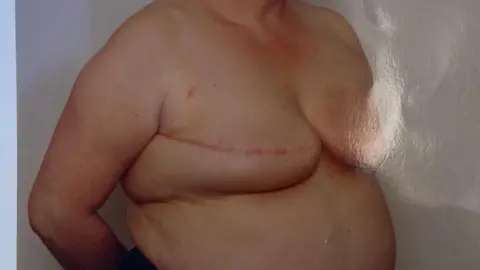 Handout A medical photo showing Marie Pinfield's breasts after her second mastectomy. There is still visible volume left in the breasts and there is a long red scar across them.