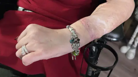 BBC/Kate Bradbrook A left hand with two rings and a bracelet. Above the bracelet there is a prominent scar where the limb was transplanted.