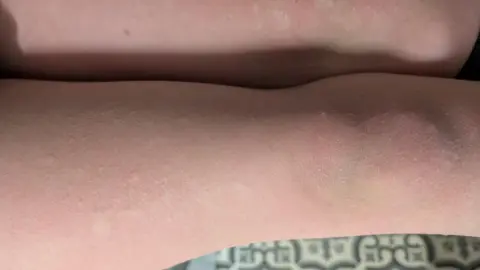 PA Media Overhead view of Amber's thighs and knees covered in hives