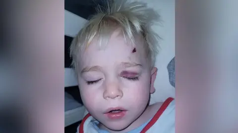 A blonde toddler with facial injuries, including bruising on his left eyelid and a cut above his left eye. His eyes are closed and his mouth slightly open.