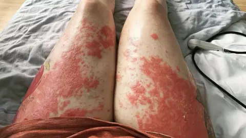 Submitted The image shows a blistered red rash on Laura's legs. 