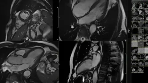 BBC News Heart Scan