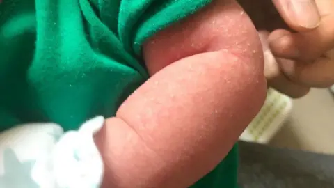 Submitted Hayden's arm with eczema